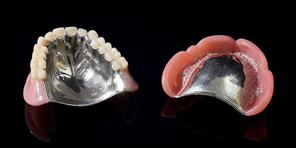 メタルサポート義歯（金属床）